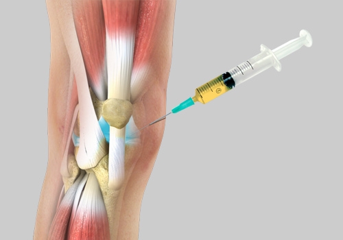 Can PRP Help Your Knee Arthritis?