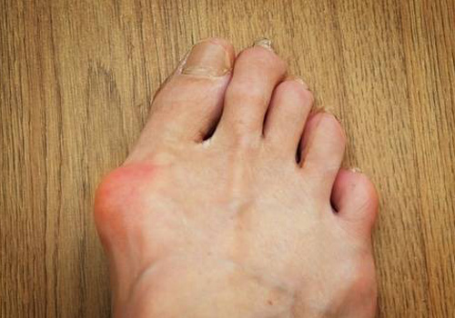 What is Hallux Valgus & How Do You Treat It?