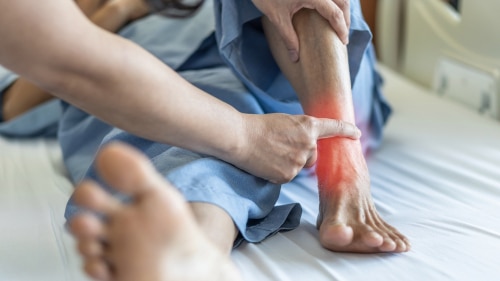 What is Ankle Arthritis & How Do You Treat It?