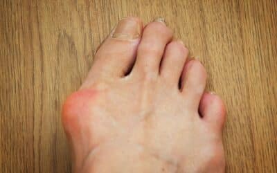 What is Hallux Valgus & How Do You Treat It?