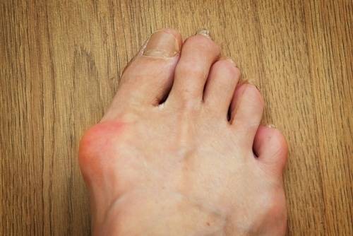 What is Hallux Valgus & How Do You Treat It?